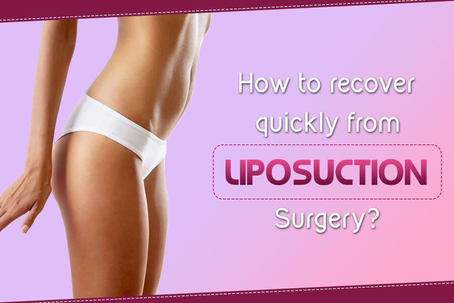 How to Recover Quickly from Liposuction Surgery