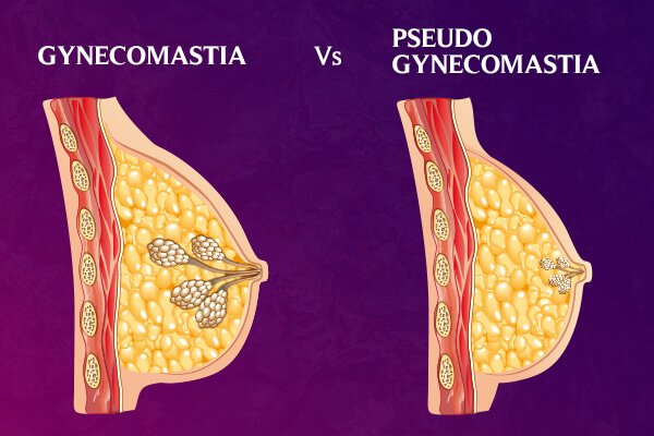 Gynecomastia vs Pseudogynecomastia- Know the Difference