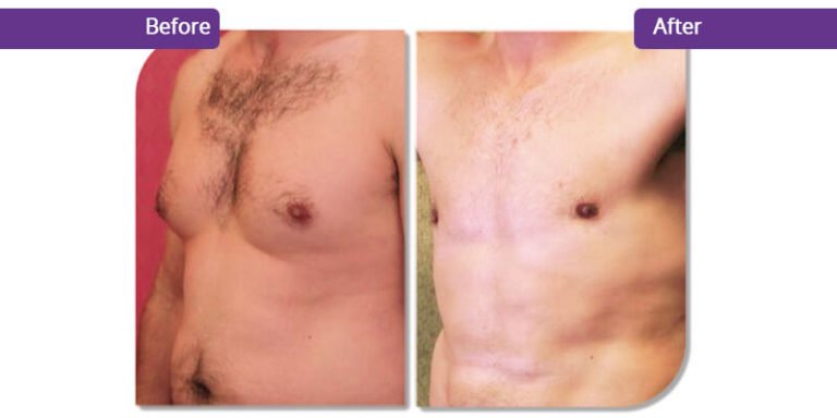 Gynecomastia Causes Symptoms Diagnosis And Treatment