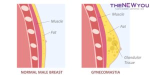 Gynecomastia Problem