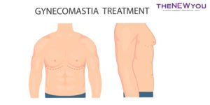 Gynecomastia Problem