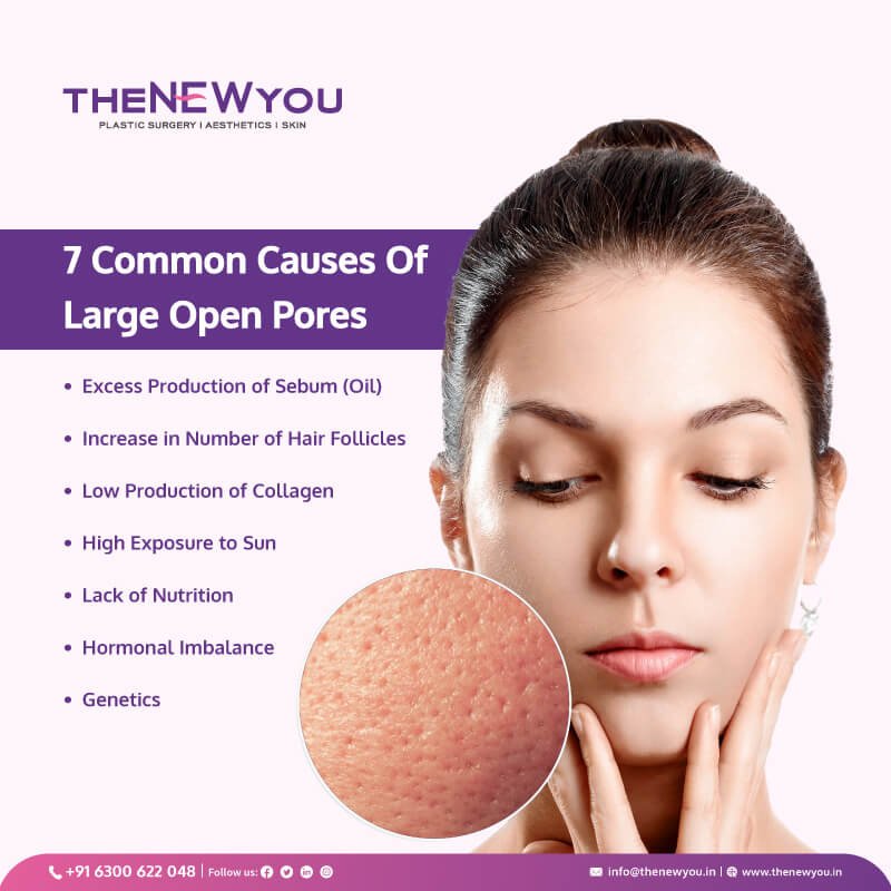Treatment For Open Pores On Face In Hyderabad 5 Advanced Procedures