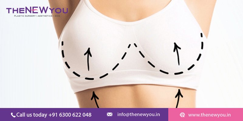 Mastopexy (Breast Lift Surgery): Cost, Benefits & Recovery