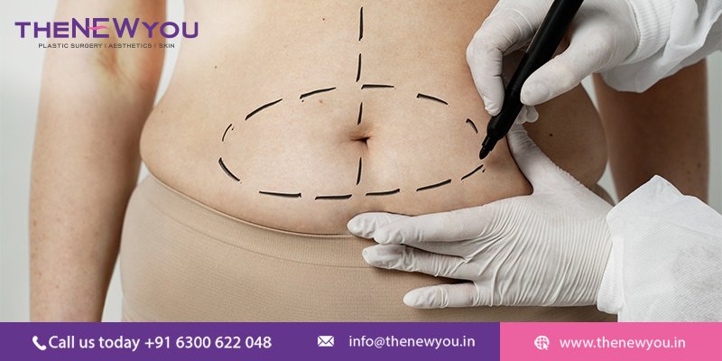 Belly Fat Removal Surgery