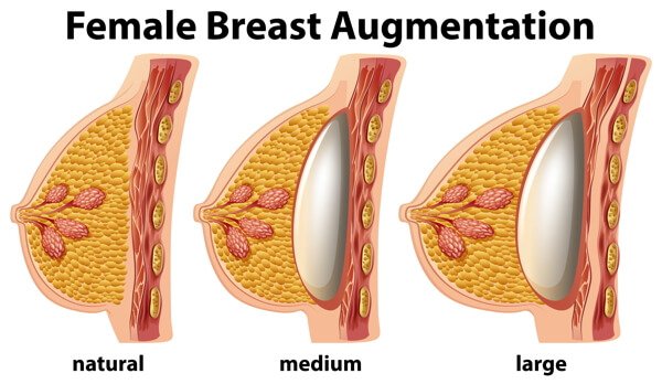 Breast Augmentation Surgery: Best Way To Increase The Breast Size
