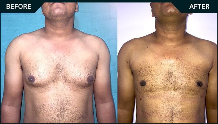 Before-after-gynecomastia-1