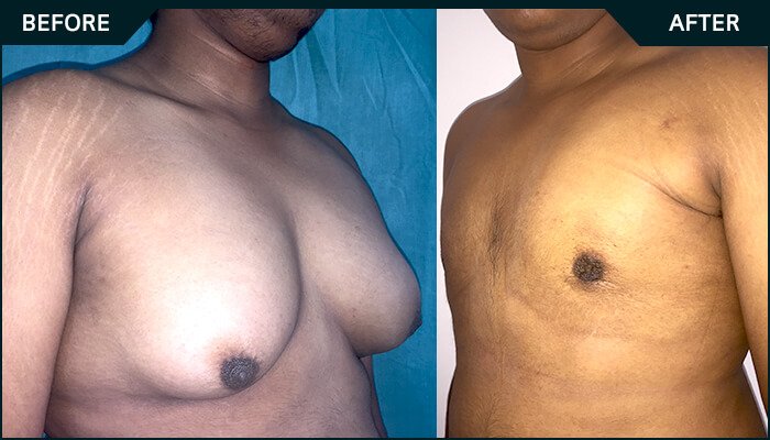 Before-after-side-gynecomastia-2