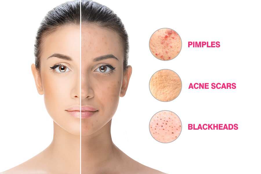 How To Treat Acne Best Acne Issues Solutions To Look Beautiful