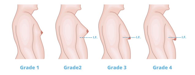 Type 4 Gynecomastia definition and treatment options