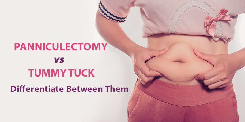 Panniculectomy vs. Tummy Tuck